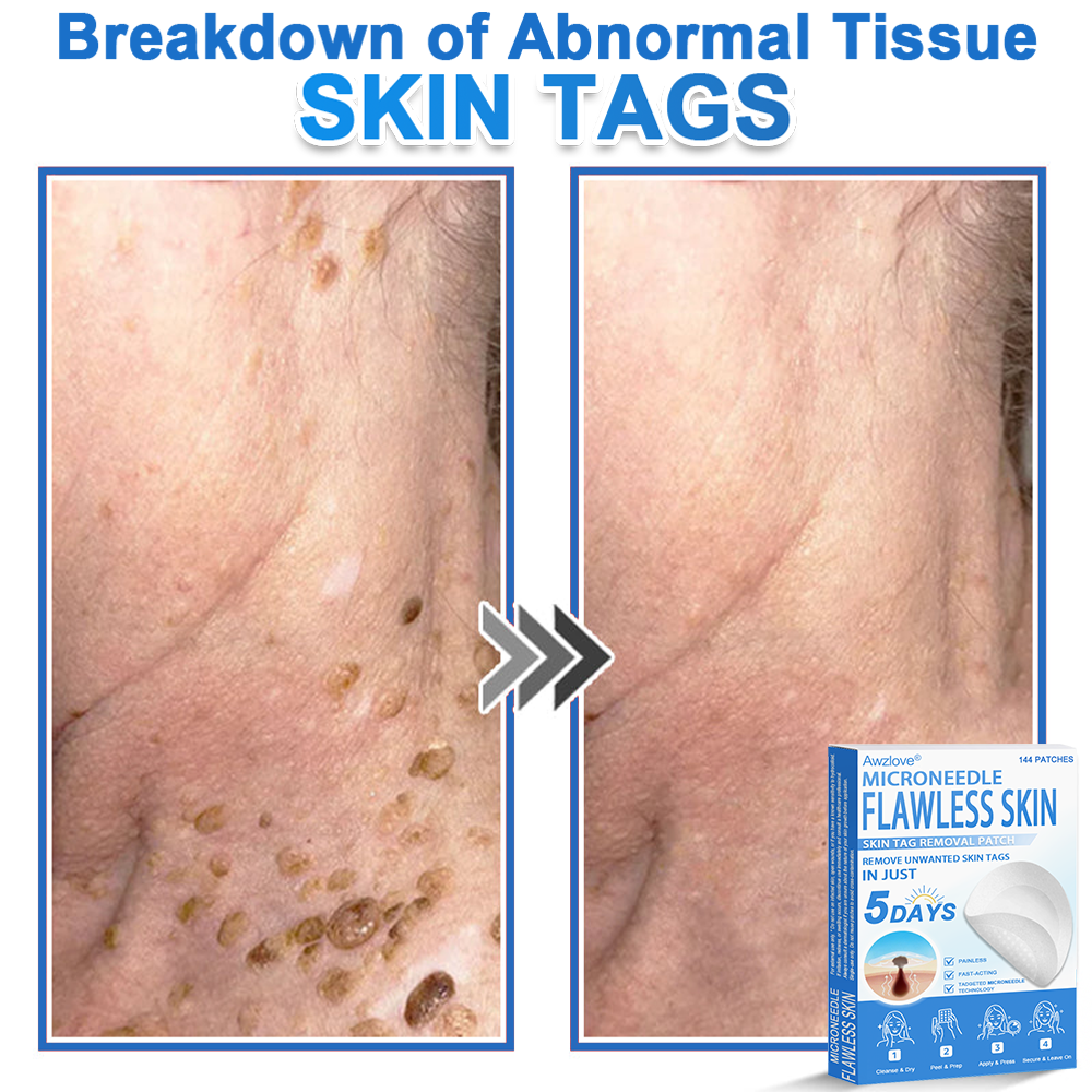 📌 Awzlove® 2-in-1 Microneedle & Hydrocolloid Patch | Raised Moles,Acne,  Flat Warts & Skin Tags Remover | Improves Wrinkles, Scars & Blemishes | Invisible Star Pimple Patches for Face & Body |🎀