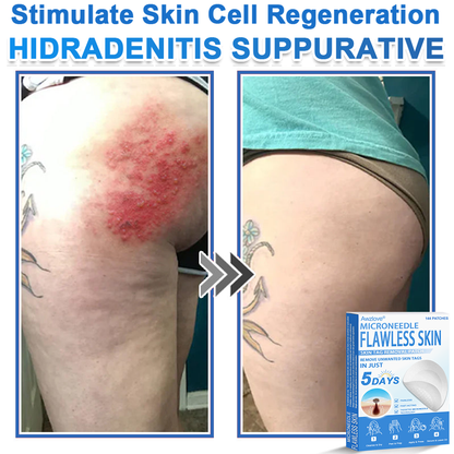 📌 Awzlove® 2-in-1 Microneedle & Hydrocolloid Patch | Raised Moles,Acne,  Flat Warts & Skin Tags Remover | Improves Wrinkles, Scars & Blemishes | Invisible Star Pimple Patches for Face & Body |🎀
