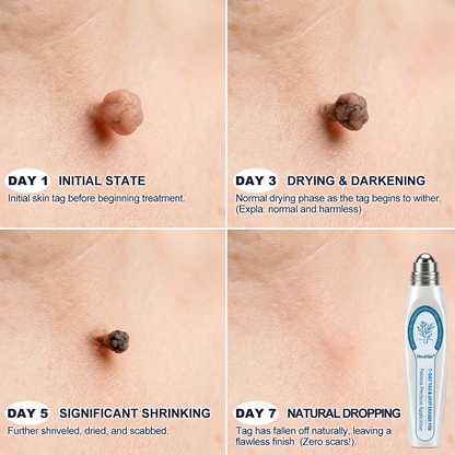 𝐇e𝐚𝐥𝐫i𝐳e® 7-𝐷𝑎𝑦 𝗧𝐚𝐠 & 𝗦𝗽𝐨𝐭 𝐄𝐫𝒂𝒔𝒆𝒓(Zero Pain, Zero 𝐒𝐜𝐚𝒓𝒔 Rollerball)🌞
